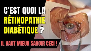 C’est quoi la Rétinopathie Diabétique [upl. by Innig127]