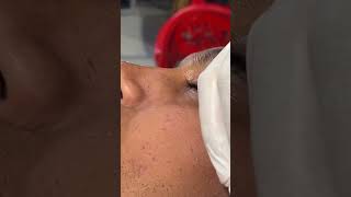 A fun new session with oily skin and black heads inside the roots [upl. by Aeht]