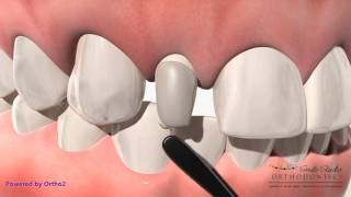 Dental Veneers Procedure Step by step [upl. by Fabyola]