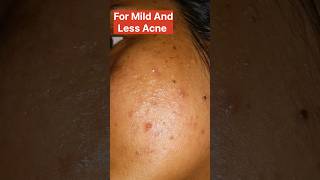 how to treat acne pimples azelaic acid or glocin gel which is better acnetreatment azelaicacid [upl. by Suiradal166]