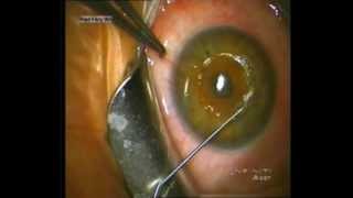 Dr Riad Fikry  Simultaneous Corneal Ring Segment Insertion and Corneal Crosslinking [upl. by Kellsie356]