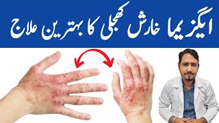 Magical Remedy For Eczema  Irfan Azeem [upl. by Singband]