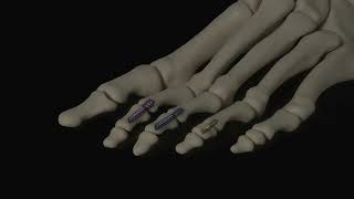 TwoStep Hammertoe Implant System Animation [upl. by Arval111]