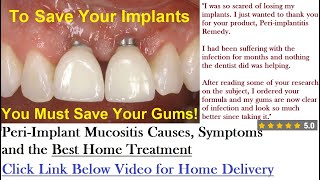 Peri Implant Mucositis Causes Symptoms and the Home Treatment That Works [upl. by Nosnhoj179]