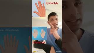 Syndactyly and polydactyly short viralvideo viralstatus shortvideo motivation [upl. by Edualcnaej436]