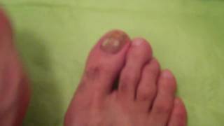 TOENAIL FUNGUS DOCUMENTARY DAY 1 [upl. by Witcher496]