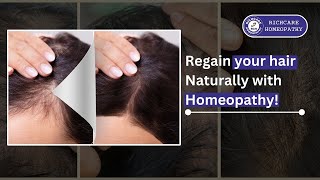 Hair fall Homeopathy Treatments Bangalore DrSham Shundar MDHom  Phone Call Question And Answer [upl. by Eilujna98]