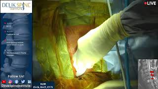 Watch Live Spine Surgery Deuk Laser Disc Repair C5C6 C6C7 C7T1 [upl. by Kore565]