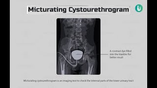 Anterograde Urethrography Xray  Micturating CystoUrethrogram Xray [upl. by Lindberg]