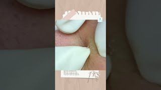 Big Cystic Acne Blackheads Extraction Blackheads amp Milia Whiteheads Removal Pimple Popping [upl. by Cleavland912]