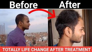 Homeopathy Result After Use 5 Month।Sonu Kumar Mishra। [upl. by Fronnia]