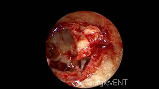 Endoscopic tympanosclerosis and atresia EAC surgery [upl. by Luba]