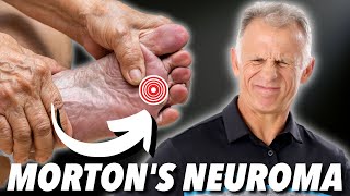 Mortons Neuroma Absolute Best Treatment In Our Opinion [upl. by Eittol]