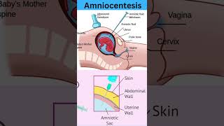 Amniocentesis amniocentesis kya hota h amniocentesis NEETUG Nursing pregnancy childbirth [upl. by Liborio922]