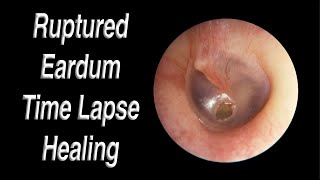 Ruptured Eardrum Healing Closed Time Lapse  A Hole in Eardrum Usually Heals Closed on Its Own [upl. by Tildi602]