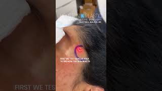 Laser treatment for hyperpigmentation oddlysatisfying hyperpigmentation [upl. by Poock396]