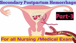 Secondary Postpartum HemorrhageIIPART3II Management of SecondaryPPH IINightingale Nursing Academy [upl. by Yard504]