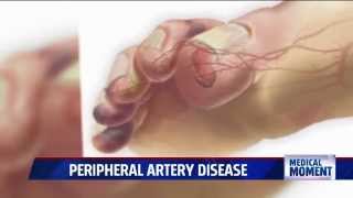 Symptoms and Treatments for Peripheral Artery Disease PAD [upl. by Michon]