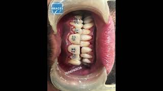 Class 2 div 1 Malocclusion  BRACES trending dentist toothdental dentalcare dentalclinic tooth [upl. by Ahselak]