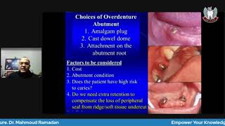 Tooth Supported Overdenture Part 3 Treatment planning and clinical procedures [upl. by Bernardo252]