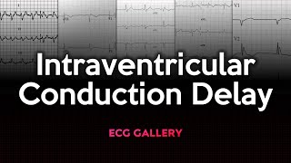 Intraventricular Conduction Delay ECG Gallery [upl. by Gilberto293]