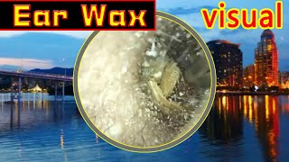 Ear wax removal amp Ear Cleaning （6） [upl. by Sapienza]