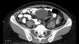 Tomografia Abdomen  poliquistosis hepática [upl. by Ahsoet]