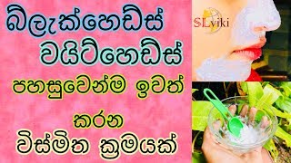 බ්ලැක්හෙඩ්ස් වයිට්හෙඩ්ස් පහසුවෙන්ම ඉවත් කරන ක්‍රමයක්  How to remove Blackheads amp Whiteheads At Home [upl. by Bikales156]