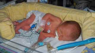 32 week Preemie Samuels Month in NICU and Year [upl. by Laram615]