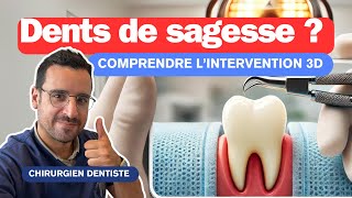 Comprendre l’Extraction DENTS DE SAGESSE [upl. by Audi]