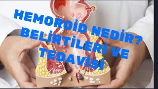 Hemoroid nedir Belirtileri ve tedavisi [upl. by Yesnik124]