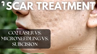 CO2 Laser vs Microneedling vs Subcision [upl. by Graig]