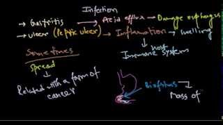 Helicobacter pylori infection [upl. by Mika]