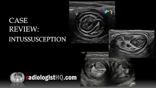 Ultrasound of Intussusception [upl. by Akinehc]