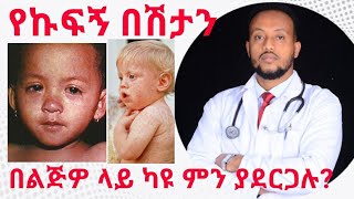 የኩፍኝ በሽታ ህክምናው Measles treatment  Dr Yonathan  kedmia letenawo [upl. by Adnol]