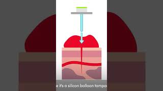 This device inflates a baloon in a stab wound [upl. by Aztiram403]