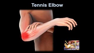 Tennis Elbow why it hurts Everything You Need To Know  Dr Nabil Ebraheim [upl. by Ahseenat]