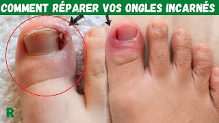 Comment réparer les Ongles incarnés rapidement et facilement [upl. by Allemac]