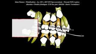 Orthodontie rapide  methodologie DAC en action [upl. by Ykcir39]