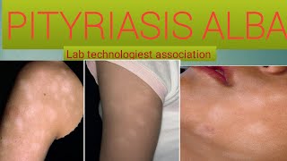 What is Pityriasis Alba The causes and treatment of pityriasis Alba [upl. by Yousuf4]