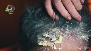 Extreme Dandruff Scratching Huge Flake And Dry Scalp Removal 29 [upl. by Nnylharas940]