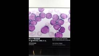 「原爆白血病（急性リンパ性白血病）」とは？〜原爆症（原子爆弾による身体の障害）〜原爆の被害を知る [upl. by Tfat]