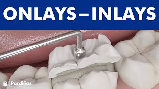 Dental inlays and onlays © [upl. by Ahsaetan]