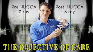 The Purpose of NUCCA Chiropractic Care [upl. by Glenn]