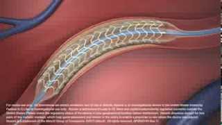 Simulacion Stent Coronario Biorreabsorbible Absorb de Abbott Vascular [upl. by Fu]