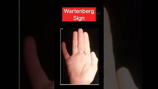 Wartenberg sign ytshorts neurology health [upl. by Yrogreg]