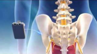 Overview of Sacral Nerve Stimulation for Urinary Control [upl. by Josh867]