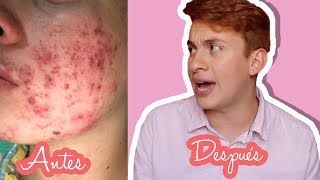 CÓMO ELIMINAR CICATRICES DE ACNE  Estas son las cremas que use  –Heeysoycesar [upl. by Reifnnej]