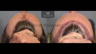 Natural Hair Transplants  The Maitland Clinic  FUE FUT PRP Finasteride [upl. by Eelrak]