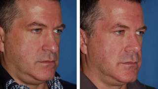 Revision Rhinoplasty Seattle  Rhinoplasty Redo [upl. by Kahlil949]